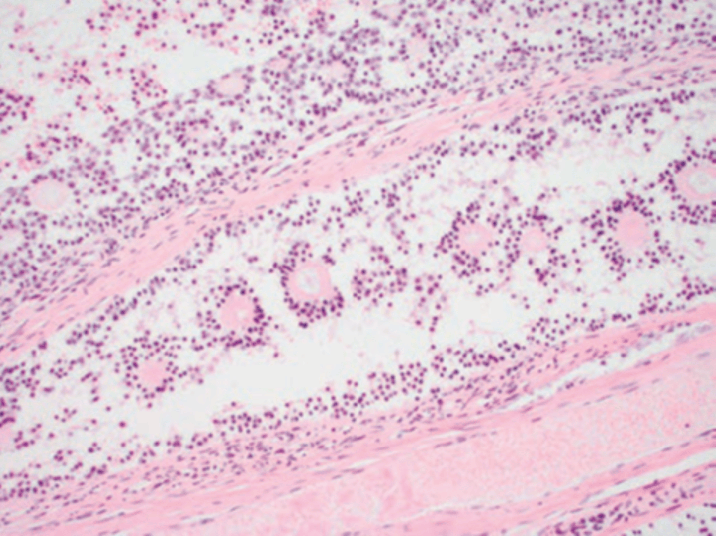 <p>Call-Exner bodies are small, fluid-filled spaces that form within the granulosa cells of the ovarian tumor.</p><p>They consist of follicular cells arranged in a rosette-like or circular pattern, and inside these spaces, there is typically eosinophilic fluid. The spaces resemble follicles but are not fully developed.</p>