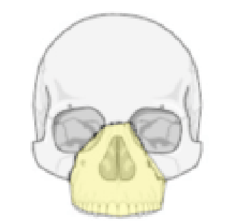 <p>What type of Le Forte fracture is this</p>
