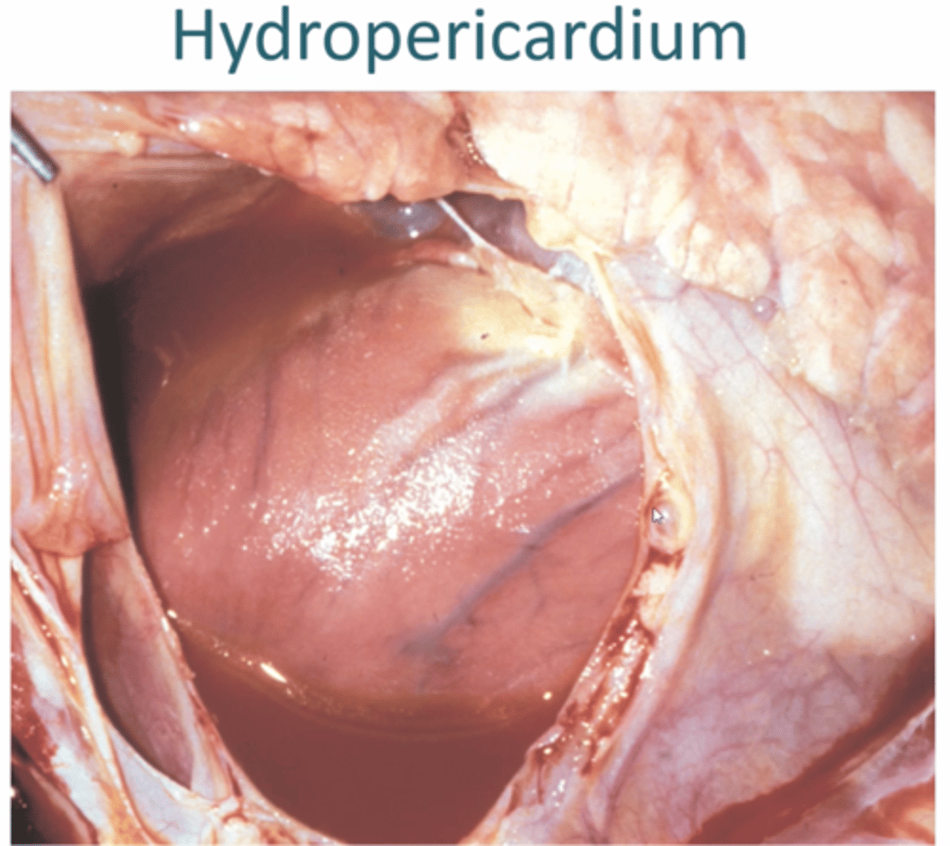 <p>1. Excess accumulation of clear, light yellow, watery serous fluid in pericardium, may contain small amounts of fibrin</p><p>2. Pericardium smooth + Glistening, Can cause cardiac tamponade (so much fluid heart cannot beat)</p><p>3. Epicardium/Pericardium may be opaque (mild fibrous thickening)</p>