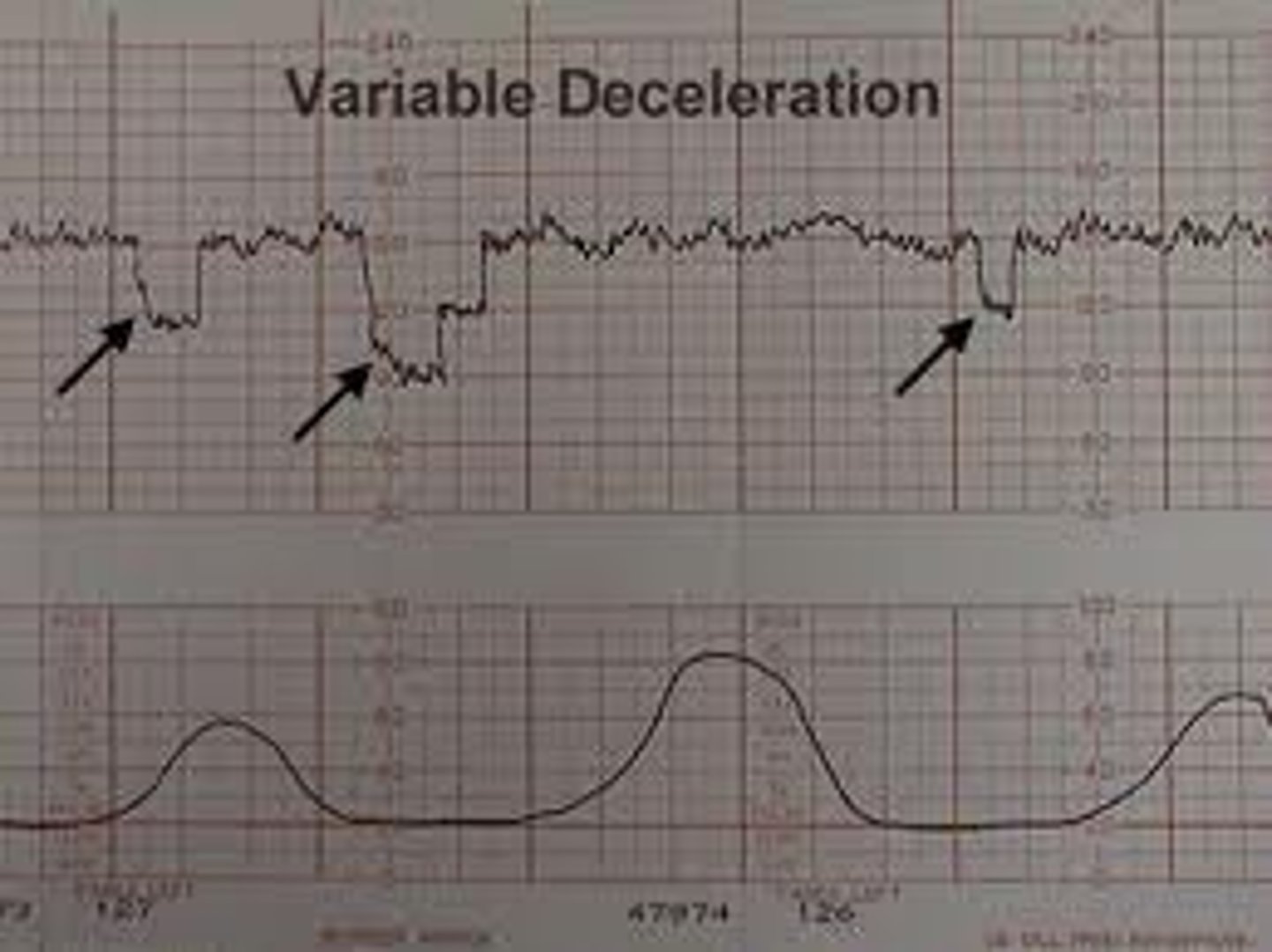 <p>decel: abrupt drop to nadir in &lt;30 sec; decrease of &gt;15 bpm for 15 sec to 2 min; may/may not be linked to ctx; associated w/ cord compression</p>
