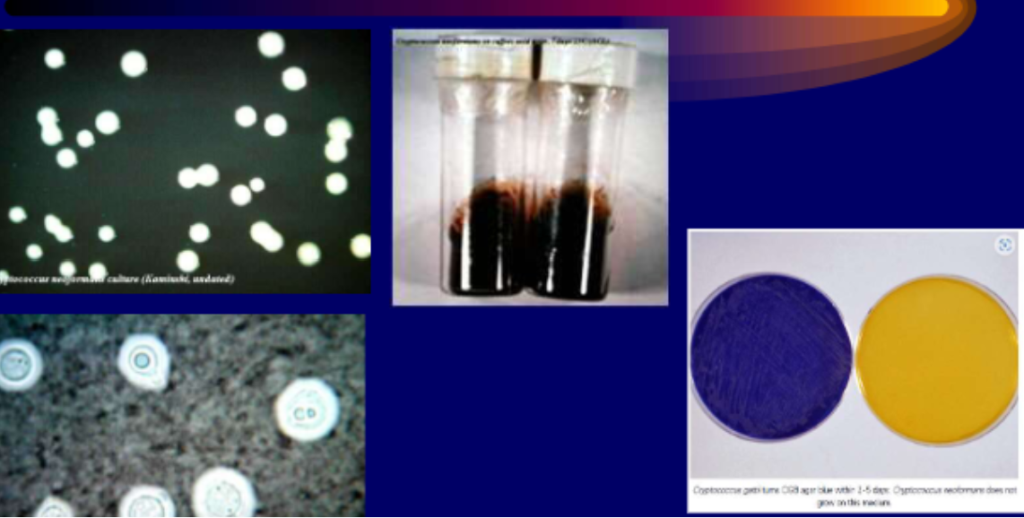 <p>Systemic mycosis, india ink shows halo surrounding yeast cell, use latex agglutination for test</p>