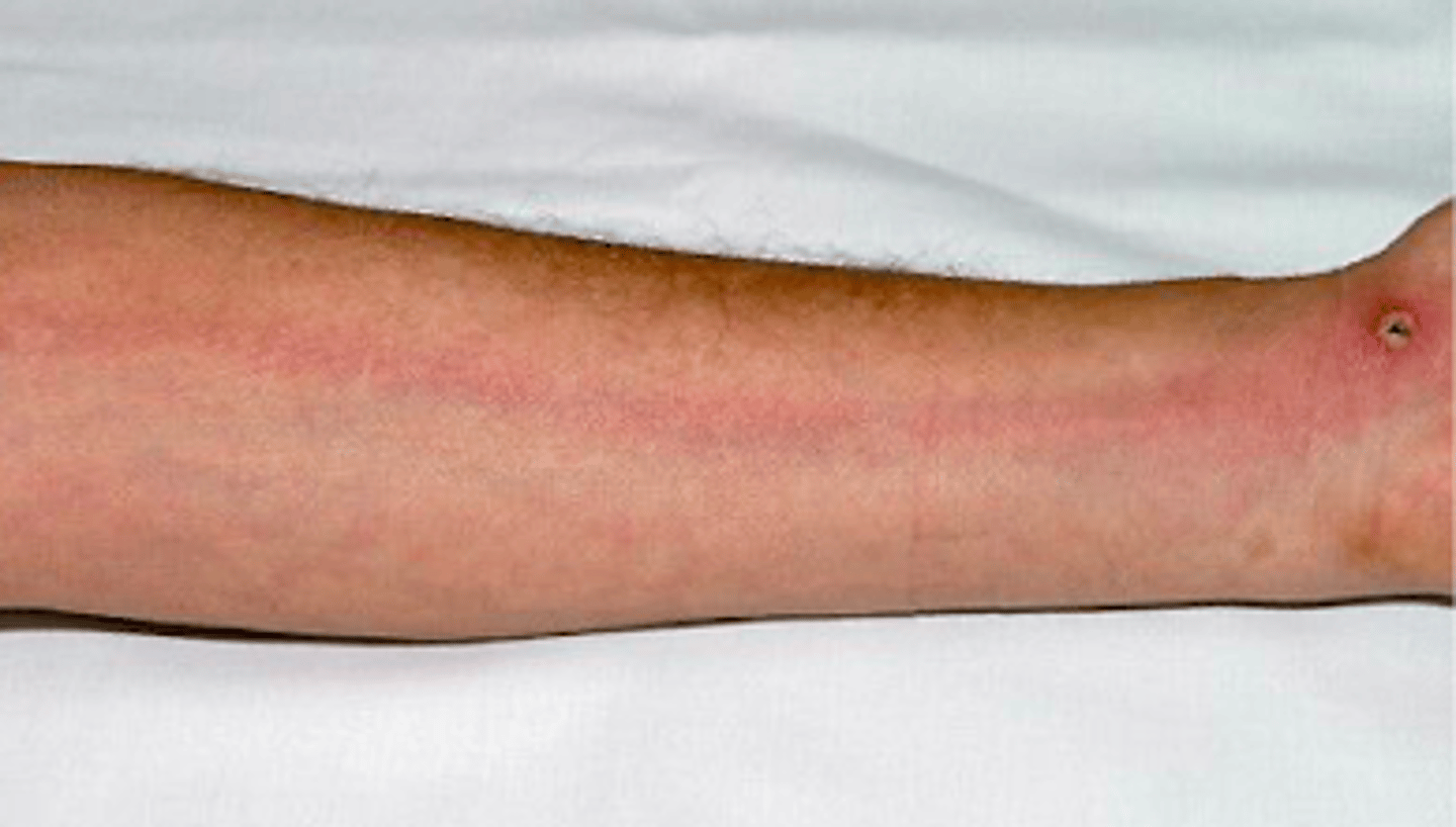 <p>Bacterial Skin Infections:</p><p>-also called cat scratched fever</p><p>described as "streaking" on PE - indicates development of cellulitis (deeper, so enters the lymph vessels) - NEED IV ABX</p>