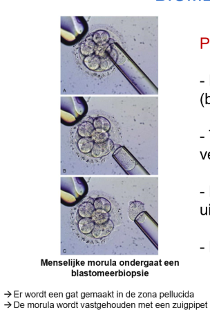 <p>= prenatale genetische diagnostiek:</p><ul><li><p>bij risico voor een aangeboren afwijking (beide ouders zijn heterozygoot)</p></li><li><p>tijdens IVF worden per embryo enkele blastomeren verwijderd</p></li><li><p>DNA onderzoek van de blastomeren wordt uitgevoerd</p></li><li><p>normale kiemen worden ingeplant</p></li></ul><p></p>