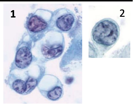 <p>frottis, diagnostic </p>