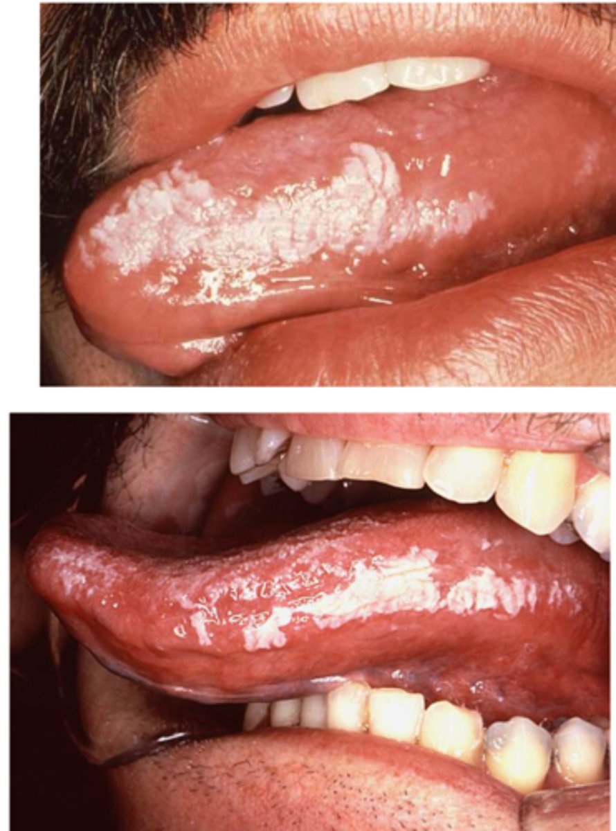 <p>Presents as a white mucosal plaque that does not rub off, usually on the lateral border of the tongue; associated with EBV and AIDS</p>