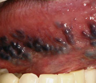<p>abnormally dilated and torturoud veins in OLDER adults, sublingual most common </p>