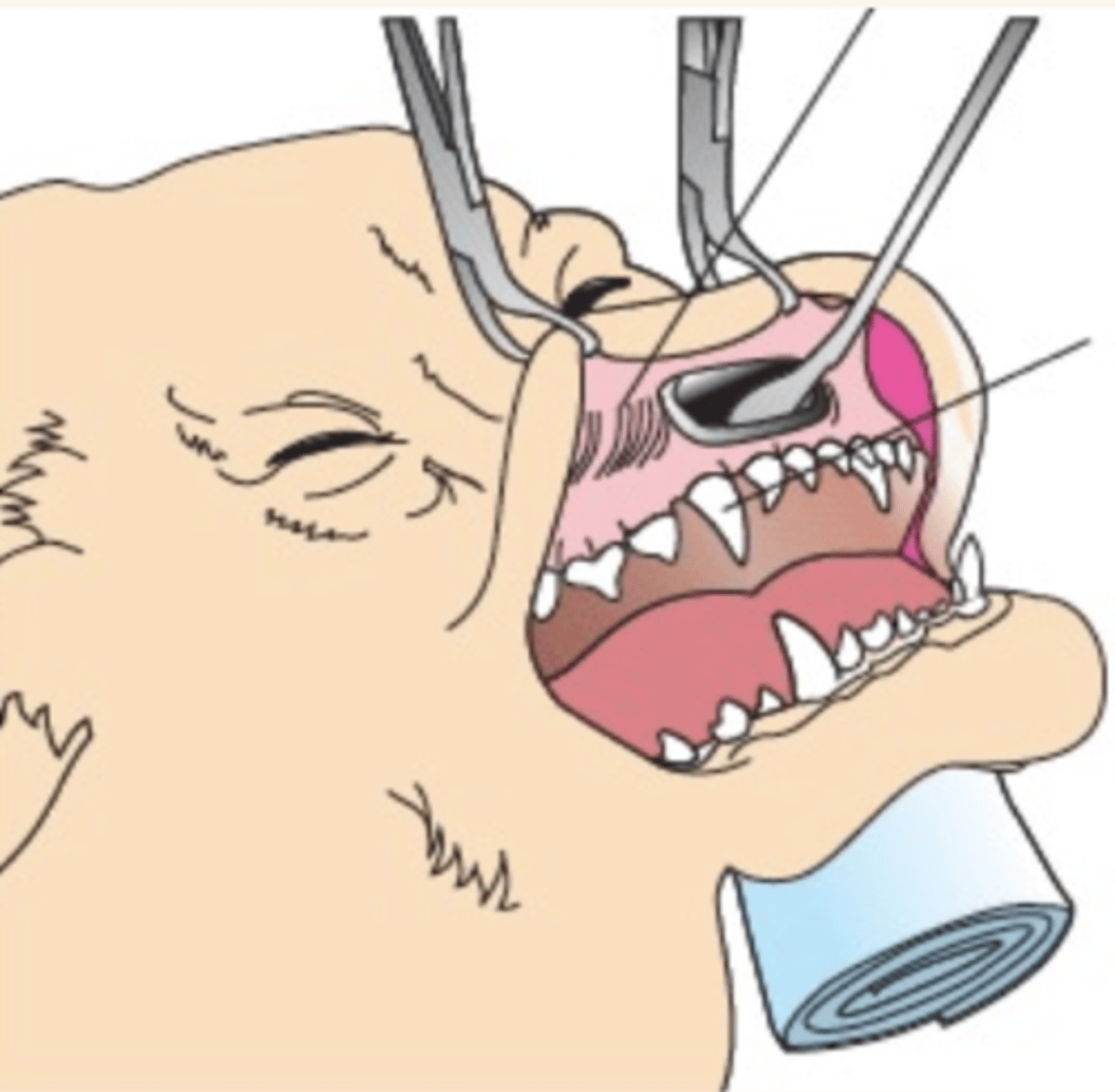 <p>intraoral-sublabial, por encima de las raíces de los dientes incisivos</p>