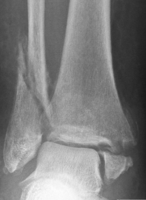 <p>What type of fracture is this?</p>