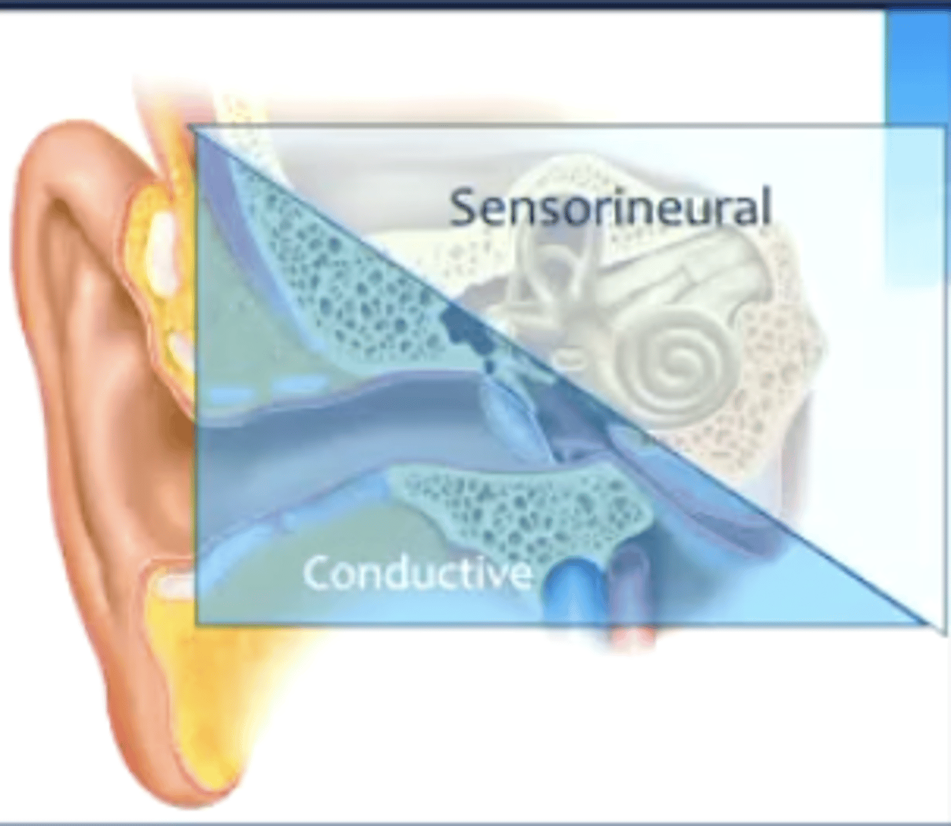 <p>conductive: mechanical issue (injury to tympanic membrane)</p><p>sensorineural: damage/loss of hair cells</p>