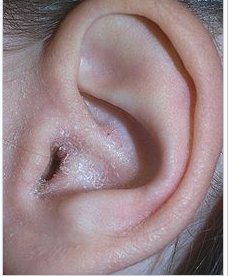 <p><span>The person reports ear pain and small amount drainage coming from their ear canal. They could possibly have which condition of the outer ear? Is it otitis externa, a preauricular fistula, or microtia? </span></p>