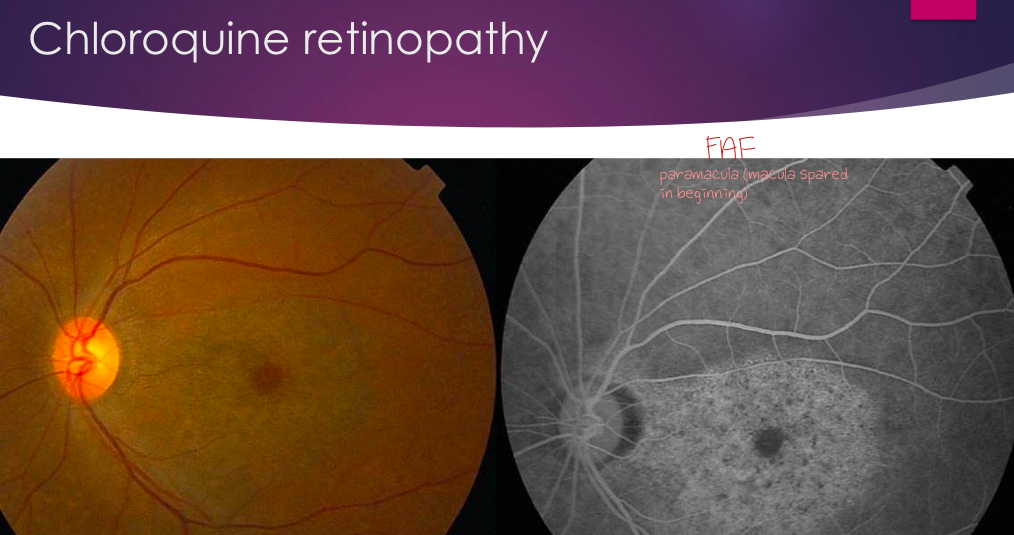 <p>what causes corneal verticillata?</p>