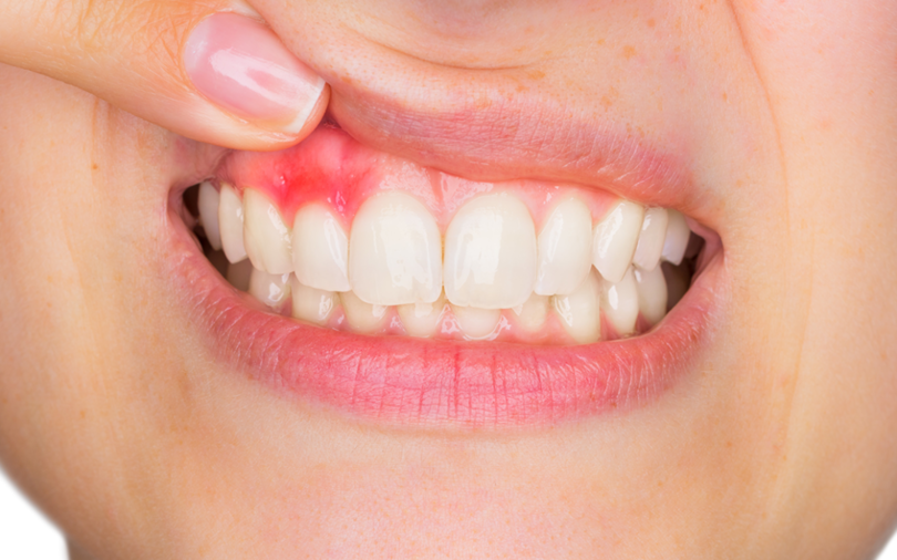<p>Gum/periodontal disease </p>
