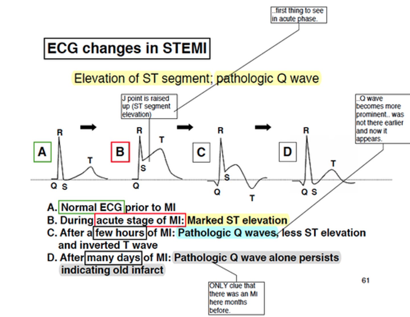 <p>ST elevation in the anterolateral leads. After a few hours, T waves invert and deep, broad, pathological Q waves develop</p>
