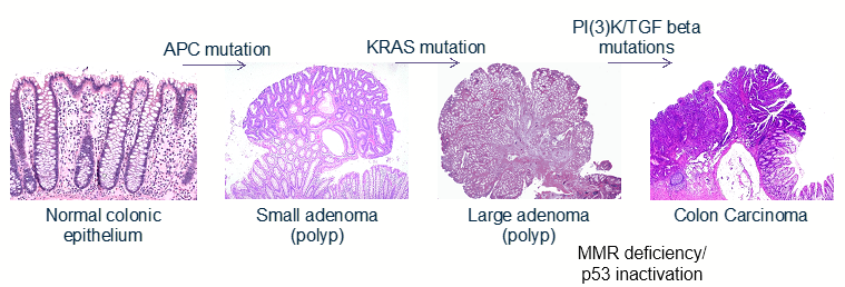 <p><span><strong>Vogelstein model. </strong>Cancer is a disease driven by increased mutational load which is thought to be acquired in a linear fashion within tumour cells.</span></p><p></p>