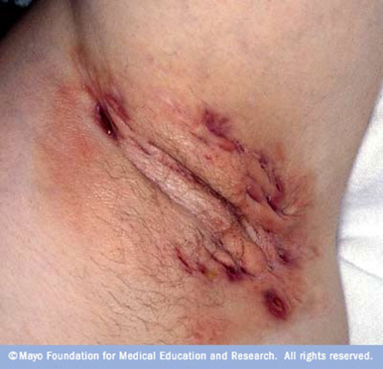 <p>Chronic suppurative disease of apocrine gland-bearing skin Involves axillae and anogenital region, rarely scalp</p><p>Onset usually at puberty</p>