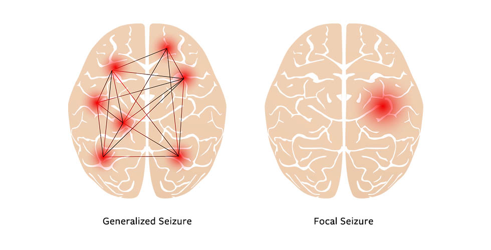 <p>Focal vs. Generalized Seizure</p>