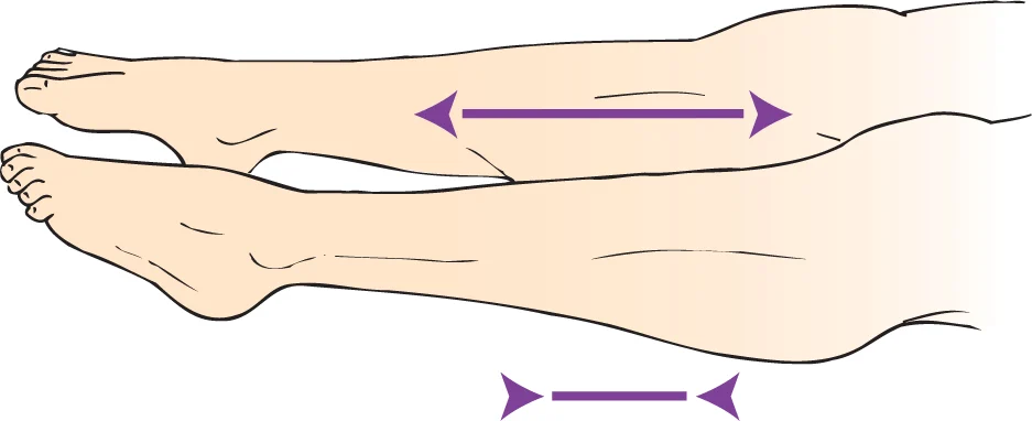 <p>foot drop</p>