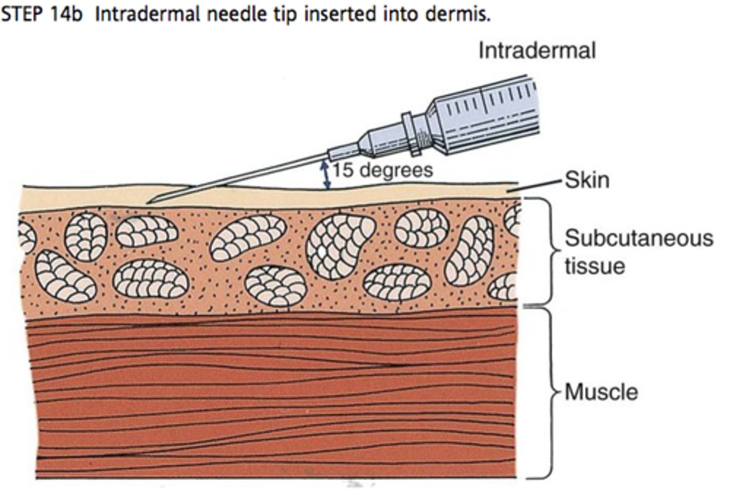 <p>Injection between epidermis and nervous</p><p>ex) TB test</p>