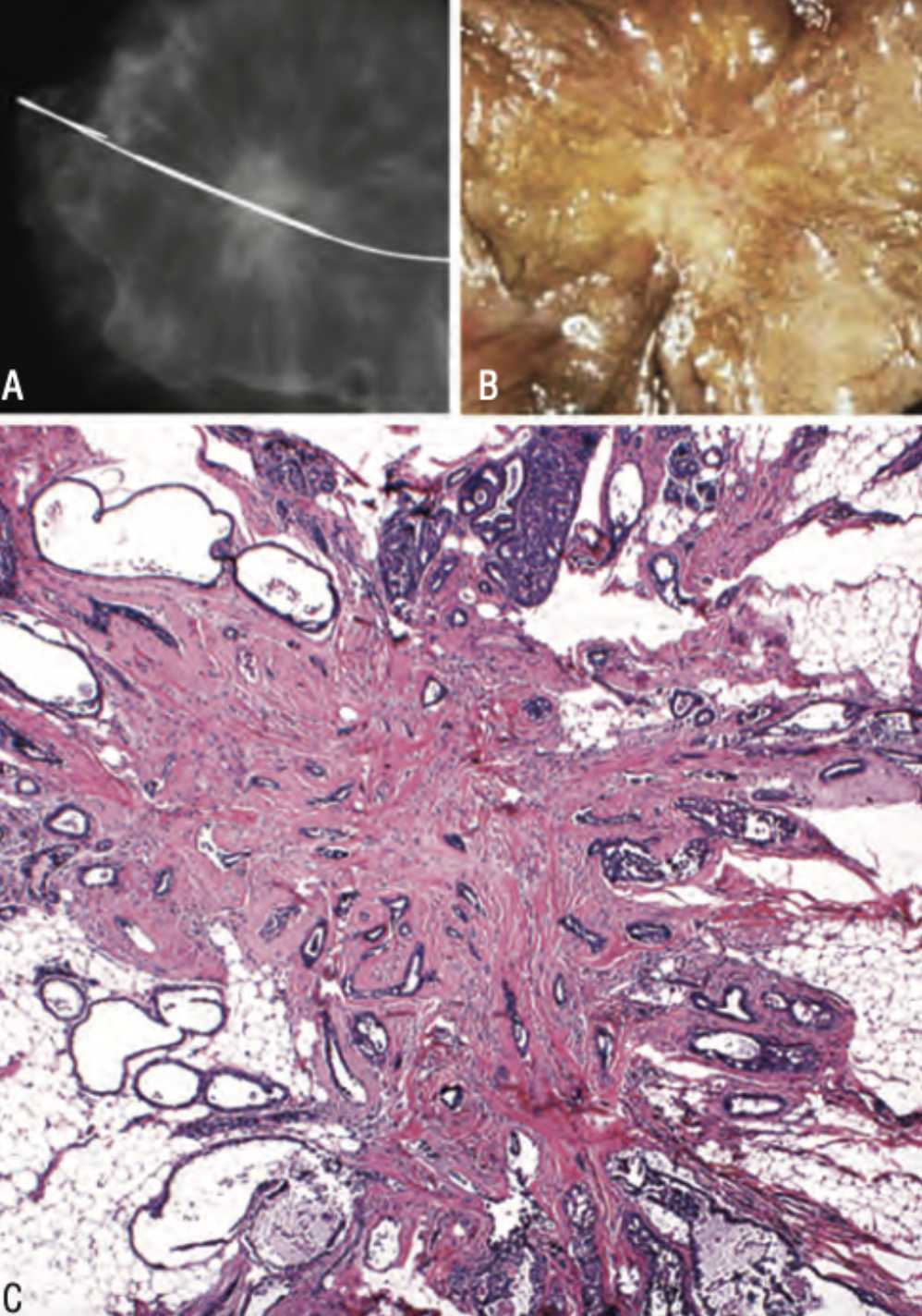 <p>glandulas atrapadas en un estroma hialinizado que se expanden radialmente simulando un carcinoma. </p>