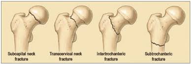 <p>What are key complications of subcapital fractures?</p>