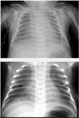 <p><strong>Transient Tachypnea of the Newborn: Diagnosis and Treatment</strong></p><p>-CXR → central vascular markings (________ ___________) and ______ in lung fissures </p><p>-Treatment → _____ ________ (resolves within 12-48 hours), may need nCPAP and/or __________</p>