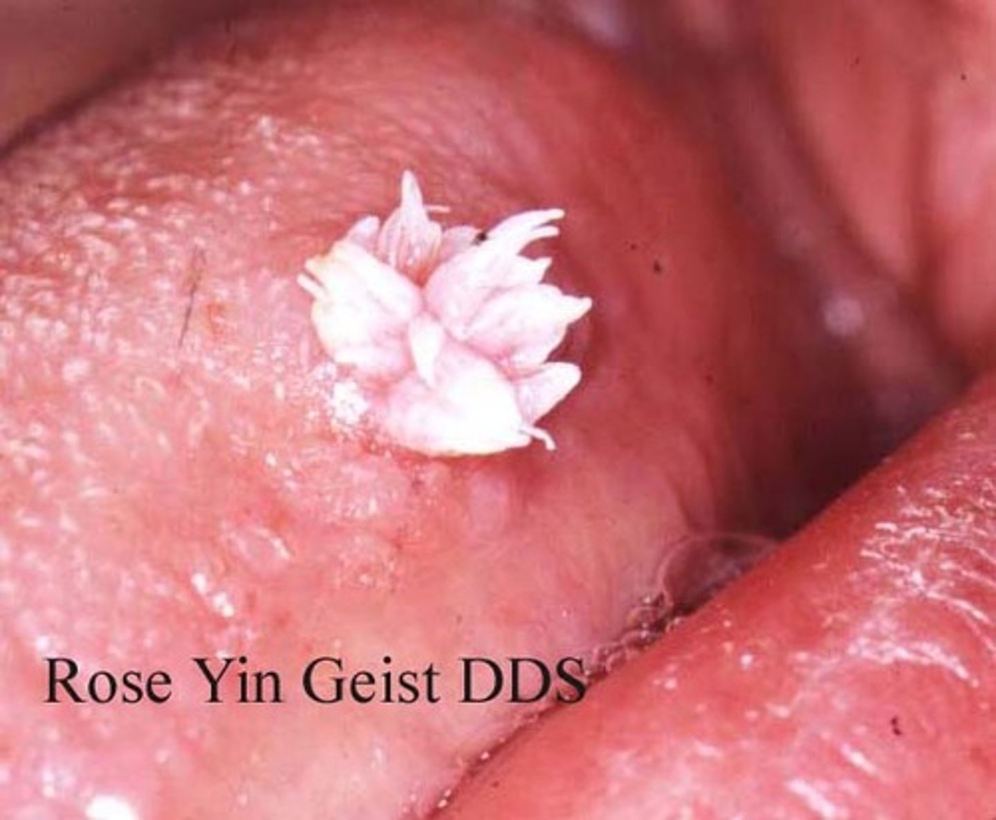 <p>Which benign epithelial lesion:</p><p>• Benign papillary or verruciform</p><p>lesion</p><p>• HPV types: 6 and 11 (low-risk)</p><p>• Very common</p><p>• Tongue, lip, soft palate</p><p>• Can occur at any age</p><p>• Asymptomatic</p><p>• 0.5 cm to 3.0 cm</p><p>• Soft, painless, exophytic nodule</p><p>• Finger-like projections</p><p>• Cauliflower or wart-like</p><p>• May be pink or white</p>
