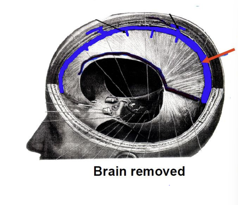 <p>What is this sinus called?</p>