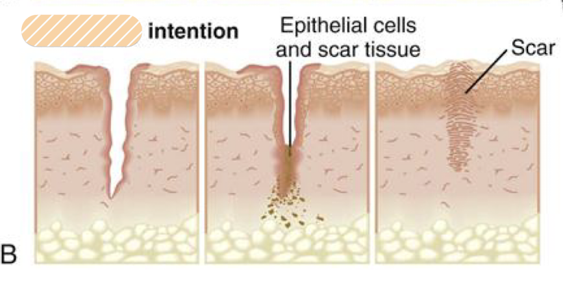 <p>What form of healing occurs <strong>when wound is left open and eventually heals through granulation tissue and migration of epithelial cells</strong>?</p>