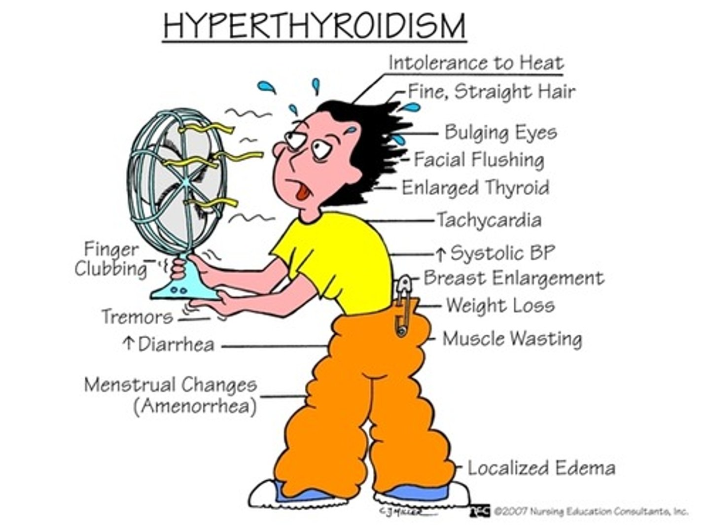 <p>1. Graves' disease is the most common cause.</p><p>2. Autoimmune antibodies result in hypersecretion of thyroid hormones.</p><p>3. Autosomal recessive trait passed to females.</p><p>4. Toxic nodular goiter, a less common form of [TERM],<span style="background-color: transparent; font-family: Arial, sans-serif, Inter, ui-sans-serif, system-ui, -apple-system, BlinkMacSystemFont, "Segoe UI", Roboto, "Helvetica Neue", "Noto Sans", "Apple Color Emoji", "Segoe UI Emoji", "Segoe UI Symbol", "Noto Color Emoji"; font-size: 1.6rem;"> is caused by the overproduction of thyroid hormone due to the presence of thyroid nodules.</span></p><p>5. Exogenous hyperthyroidism is caused by excessive dosages of thyroid hormone</p>