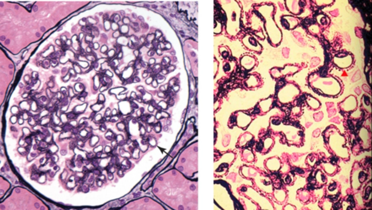 <p>-diffuse thickening of basement membrane (immune complex deposits), formation of "spikes" of the basement membrane material around deposits</p><p>-podocyte foot processes diffusely effaced</p><p>-no inflammation or increase cellularity</p>
