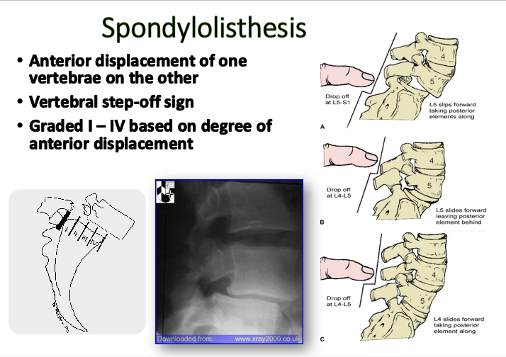 <p>•Anterior displacement of one vertebrae on the other</p><p>•Vertebral step-off sign</p><p>•Graded I – IV based on degree of anterior displacement</p><p>• Diagnosed using lateral x-rays</p><p></p><p>20% to 70% of persons with spondylolisthesis also have a spondylolysis</p><p></p><p>Backwards slippage = retrolisthesis</p>