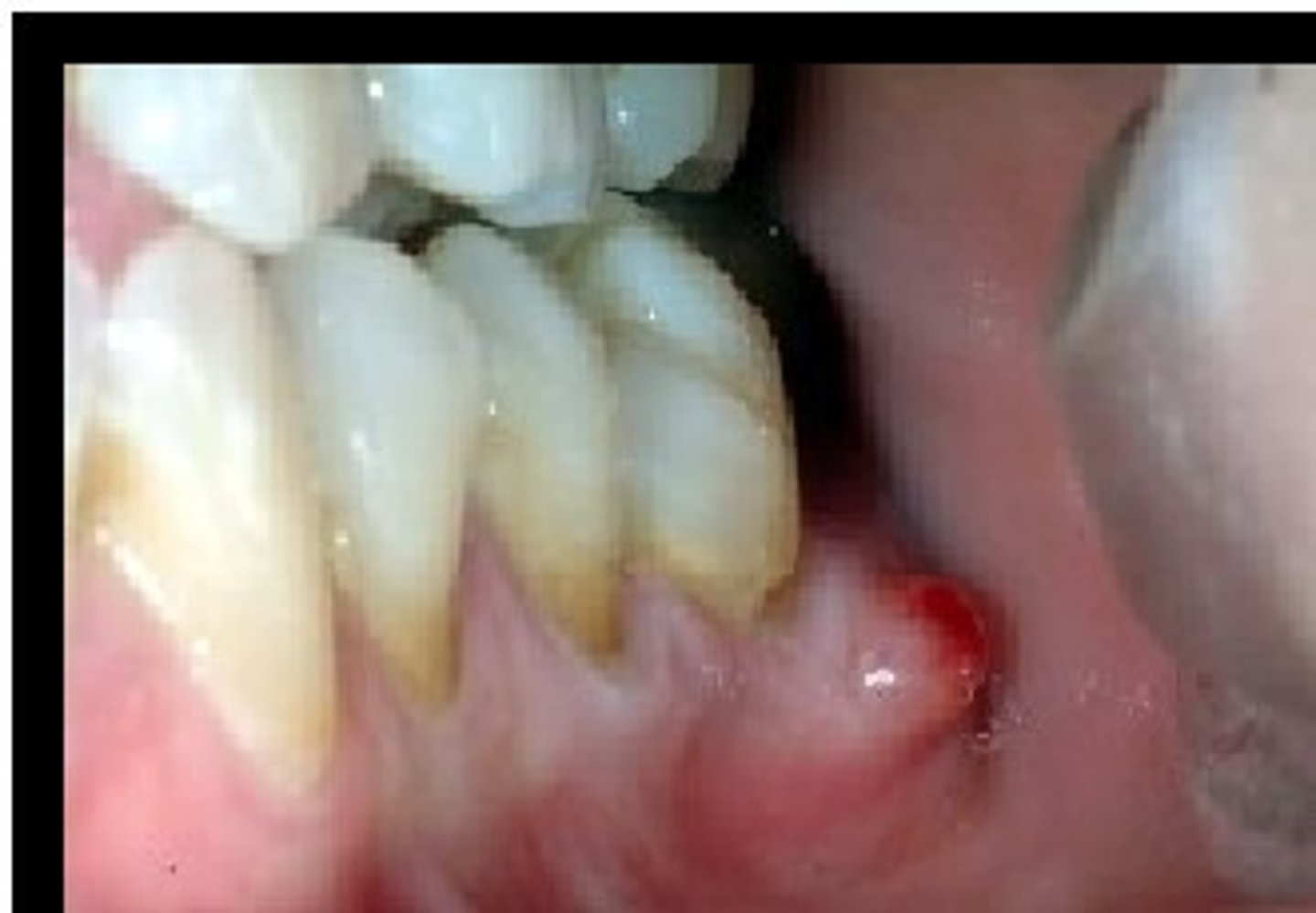 <p>yellowish-red nodule on gingiva or palate</p><p>• associated with non-vital tooth</p><p>• AKA Cutaneous sinus, gumboil </p>