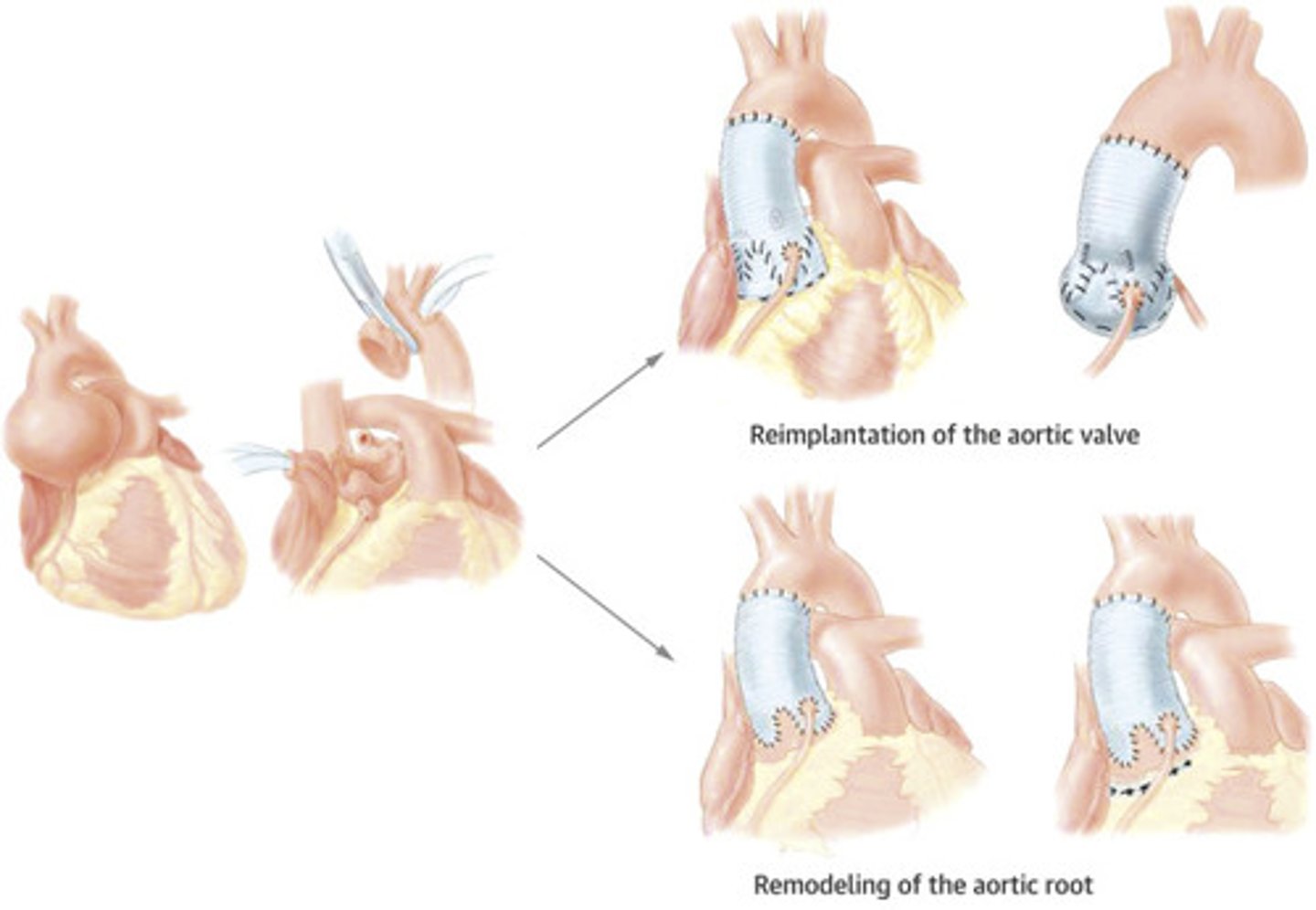 <p>Remodeling: only stabilizes the sinus of valve but not the annulus. Works best with elderly people with small annulus who you are not concerned for further dilation (DO NOT HAVE connective tissue disorders).</p><p>Reimplantation: stabilizes annulus AND sinus. Works well with Marfans patients who you worry about further dilation/regurgitation. <2% mortality. Valve competence is 90% at 20 years.</p>