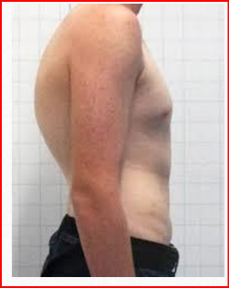 <p>Câu 24: Tật gù lưng tiếng Anh là gì?<span><span>&nbsp;</span></span></p><p class="MsoNormal">A. Kyphosis<span style="font-family: "Segoe UI Symbol", sans-serif;"><span>✓</span></span><span><span>&nbsp;</span></span></p><p class="MsoNormal">B. Lordosis<span><span>&nbsp;</span></span></p><p class="MsoNormal">C. Scoliosis<span><span>&nbsp;</span></span></p><p class="MsoNormal">D. Flat back<span><span>&nbsp;</span></span></p>