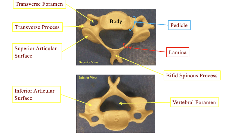 <p>Transverse forament&nbsp;</p><ul><li><p>holes on the side for the artieres to the brain. posterior sectio</p></li></ul><p>Transverse process</p><ul><li><p>the little divit on the side next to the transverse forament</p></li></ul><p>Pedicle&nbsp;</p><ul><li><p>the joining section beween the body and the forament</p></li></ul><p>Lamina</p><ul><li><p>the little thin area on the sides next to the articular surfaces</p></li></ul><p>Bifid spinous proess</p><ul><li><p>space at the posterior of the vertibrae</p></li></ul><p>supirior articular surface</p><ul><li><p>fat area at the side top portion</p></li></ul><p>inferior articular surface</p><ul><li><p>flat area at the side bottom portion ( you can tell inferior if the binfid spinous process is at the top) (posteriro</p></li></ul><p>vertebral forament</p><ul><li><p>the hole in the center</p></li></ul><p>you can tell because it has the holes&nbsp;</p><p></p>