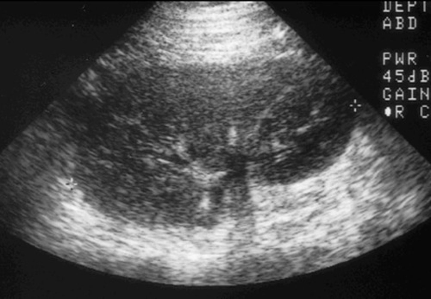 <p>Enlarged kidney</p><p>Loss of corticomedullary boarder</p><p>Decrease in diastolic flow or flow reversal</p><p>RI > 0.8</p>