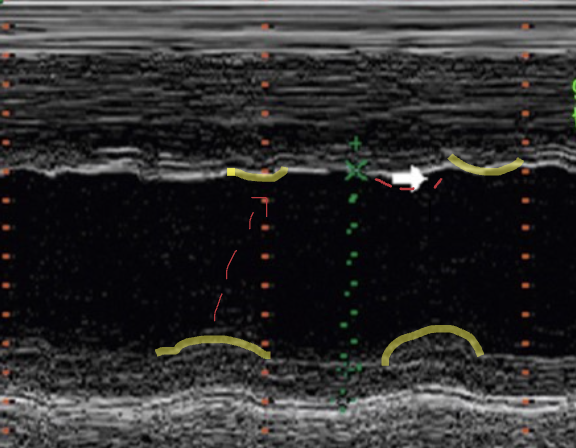<p>paradoxical septal motion due to delayed contraction of IVS</p>