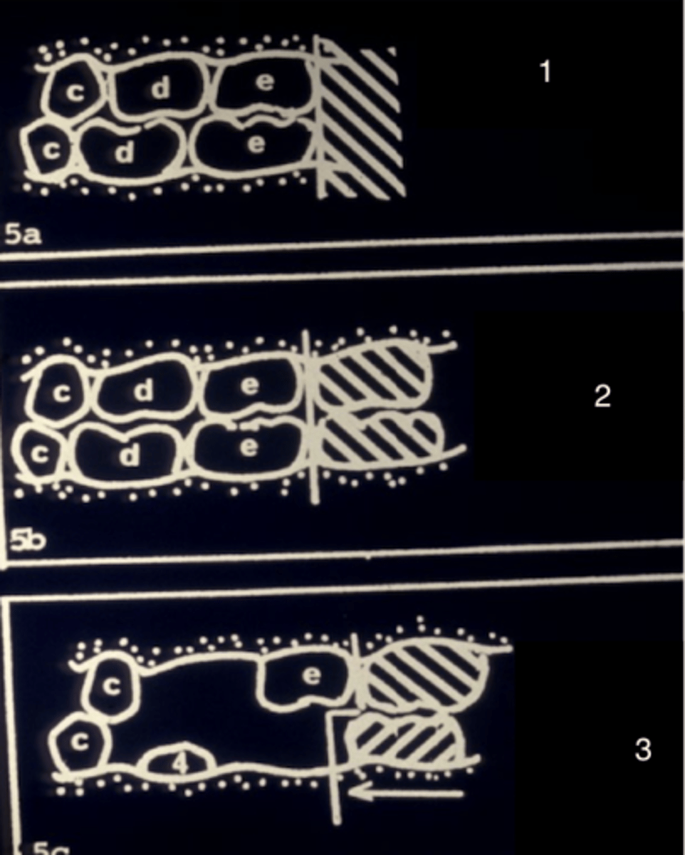 <p>What type of terminal plane is seen in the primary dentition (1)?</p>