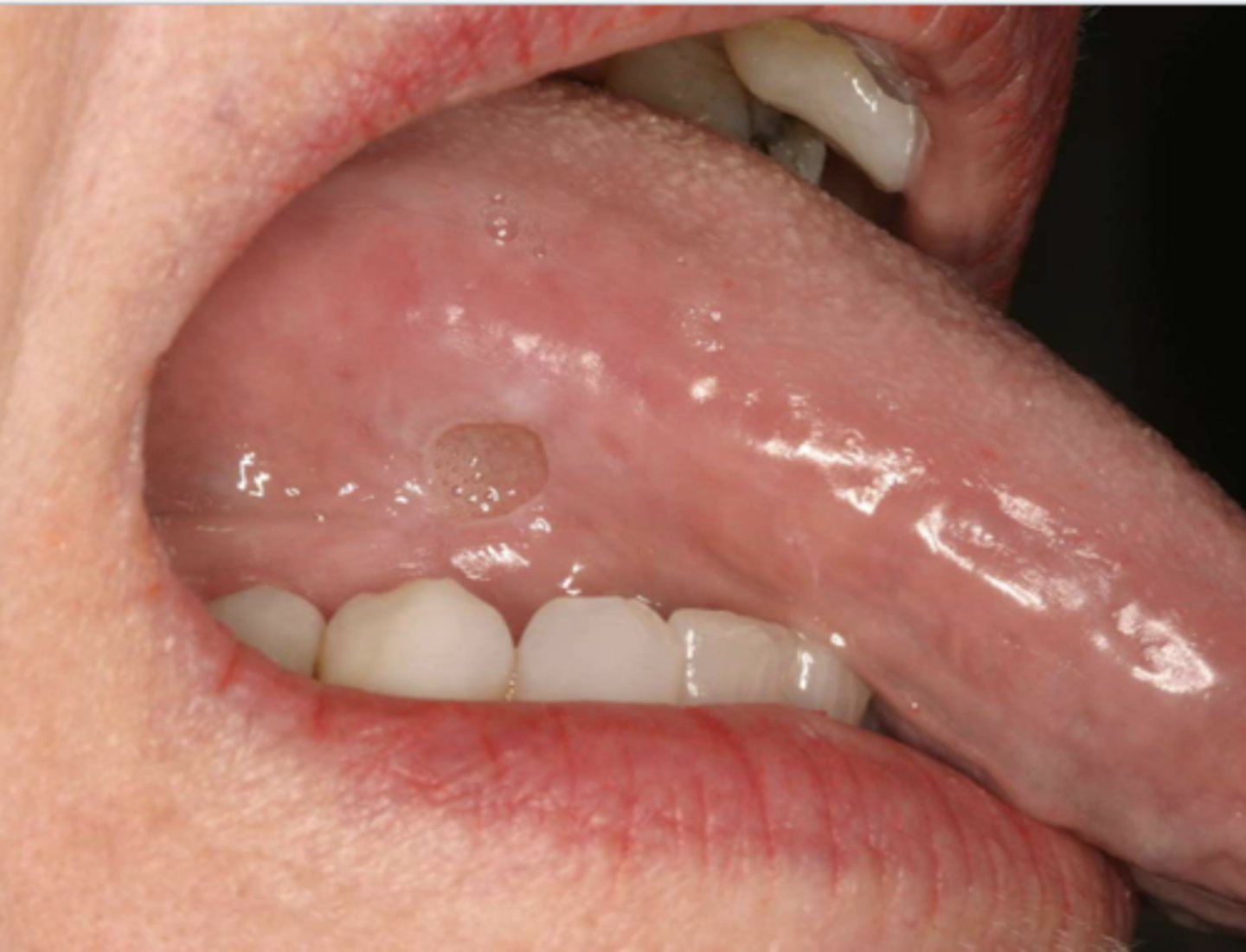 <p>What do you suspect? Patient suspected biting their tongue repeatedly over the past month</p>