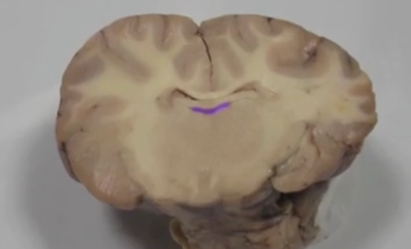 <p>Third ventricle </p>