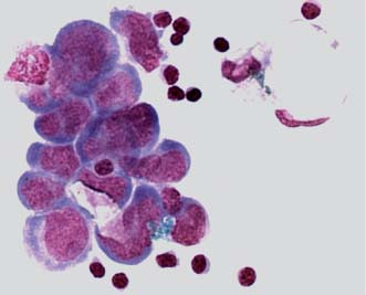 Figure 21: Astrocytoma