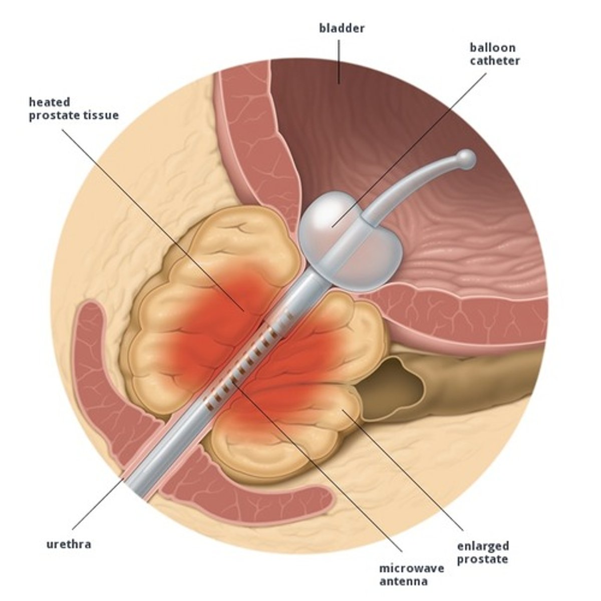 <p>treatment that eliminates excess tissue present in benign prostatic hyperplasia by using heat generated by microwave</p>