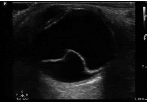 <p><span><span>Se visualiza como una membrana hiperecoica (blanca) flotando en el vítreo</span></span></p>