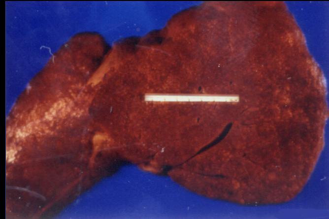 <p>“Chalky” necrosis caused by acute pancreatitis and abdominal trauma, in which tissue is replaced by fat. </p>