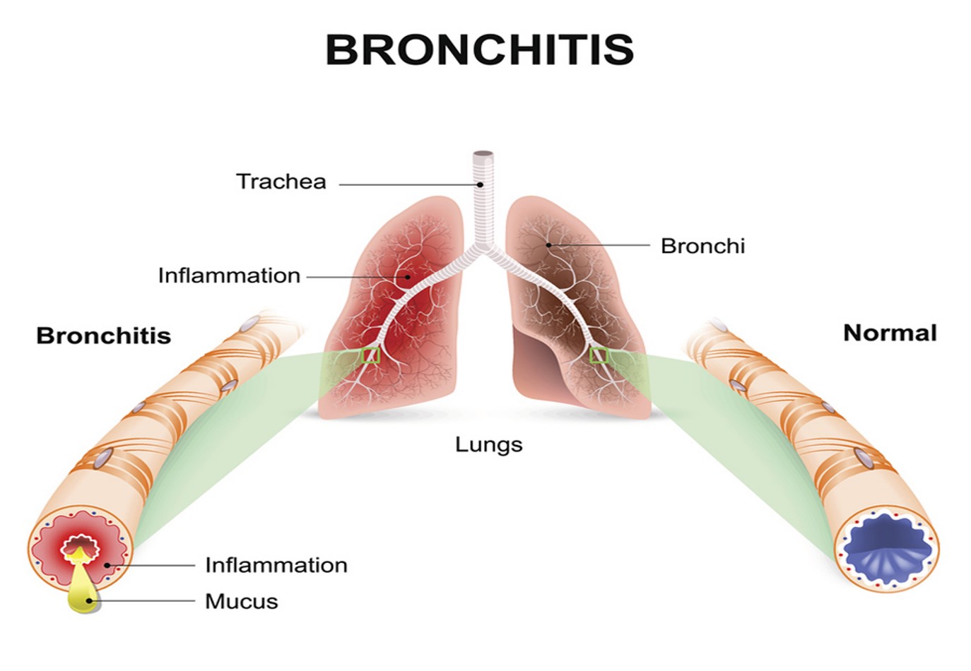 <p>Bronchitis</p>