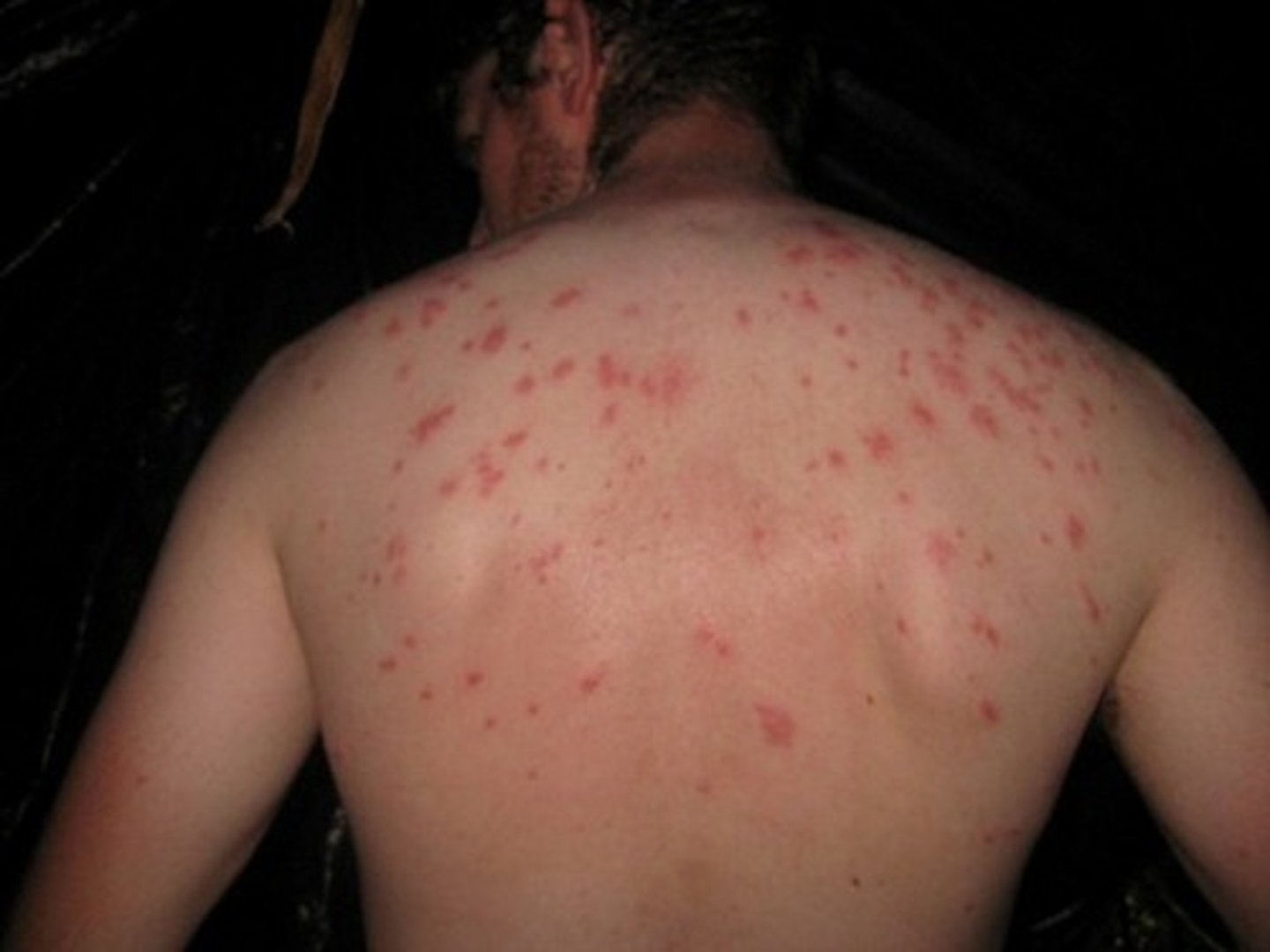 <p>Red macular rash on the chest/abdomen caused by typhoid infection</p>