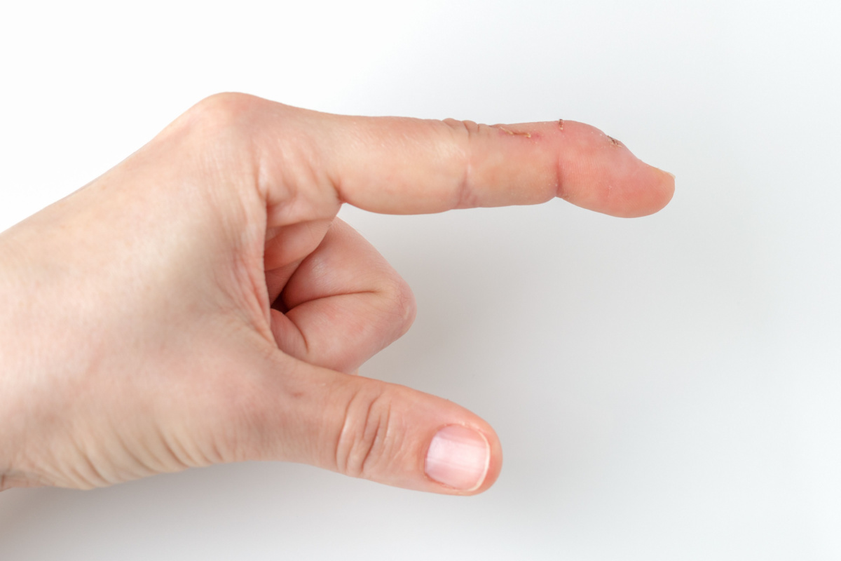 <p>A basketball player presents with a finger that cannot actively extend at the DIP joint after jamming it on the ball. Passive extension is possible. What is the most likely diagnosis?</p>