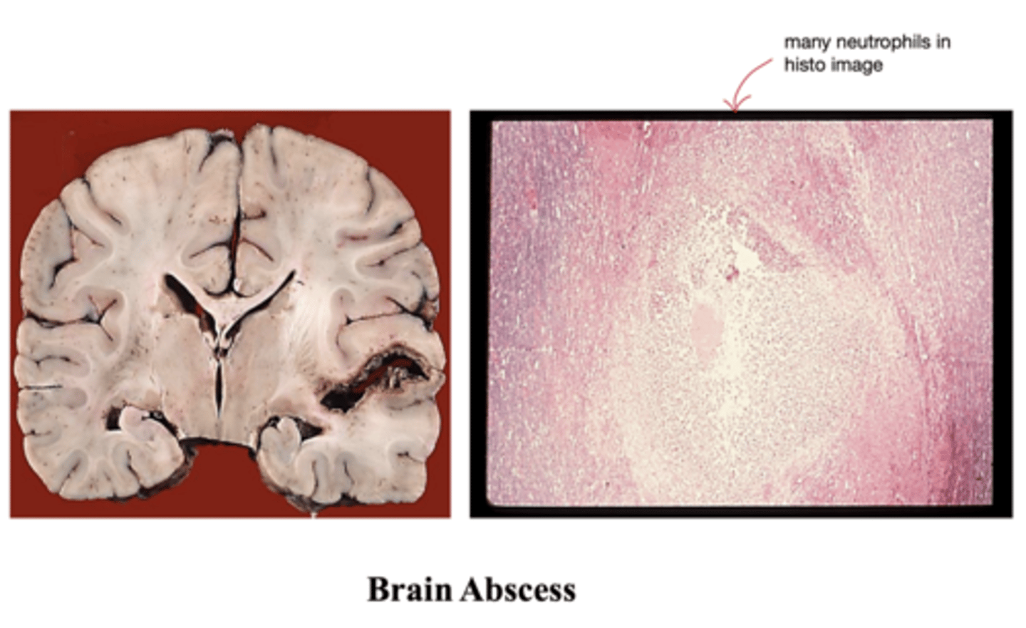 <p>What is the treatment of a brain abscess like?</p>