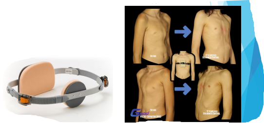 <p>Compression orthosis that is worn for 8-20 hours a day until skeletal maturity </p>