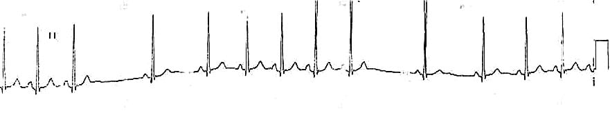 <p><strong>Second Degree SA block, Type I</strong></p>